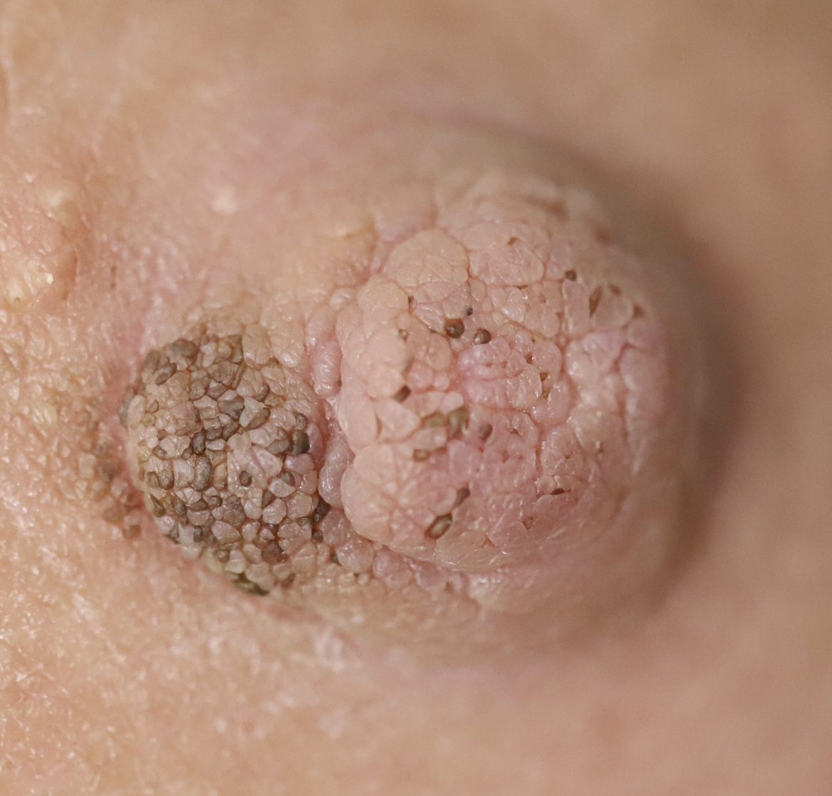 Seborrheic keratosis